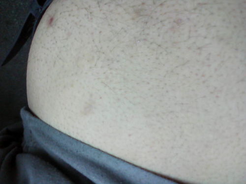 外阴白癜风可以复色吗 外阴白癜风可以复色吗