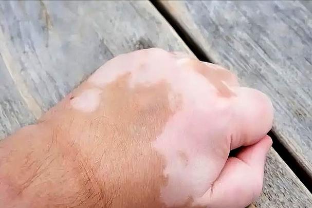 白癜风主要表现有哪些 白癜风主要表现有哪些