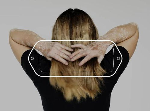 济南哪家医院治白癜风有名 白癜风能不能 济南哪家医院治白癜风有名 白癜风能不能