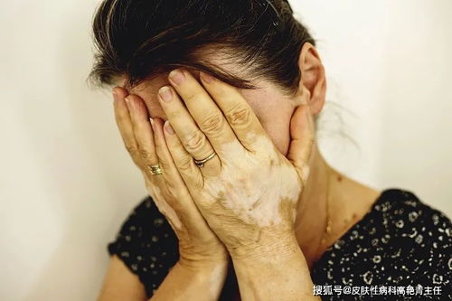 白癜风可以当海员么_白癜风可以当飞行员吗 白癜风可以当海员么_白癜风可以当飞行员吗