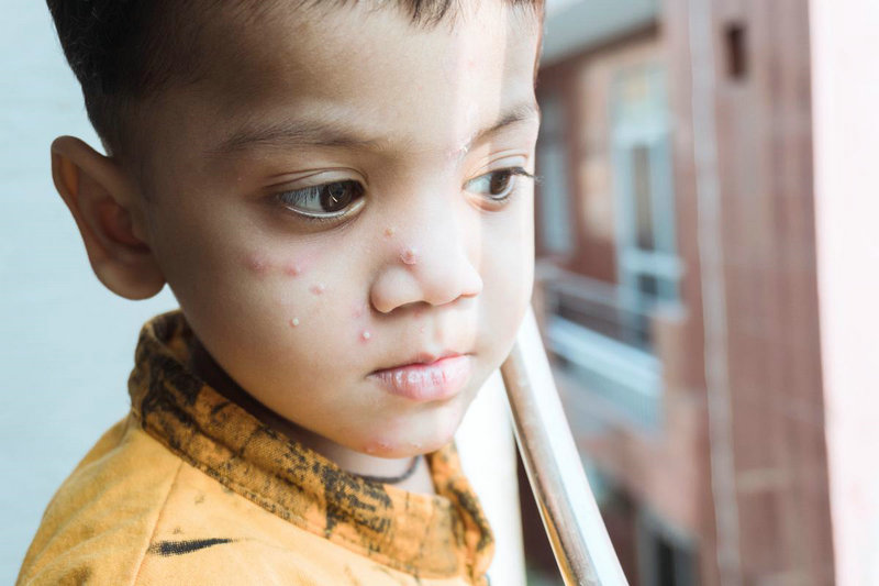 白癜风导致的并发症有哪些 宁波治白癜风的医院哪个更好 白癜风导致的并发症有哪些 宁波治白癜风的医院哪个更好