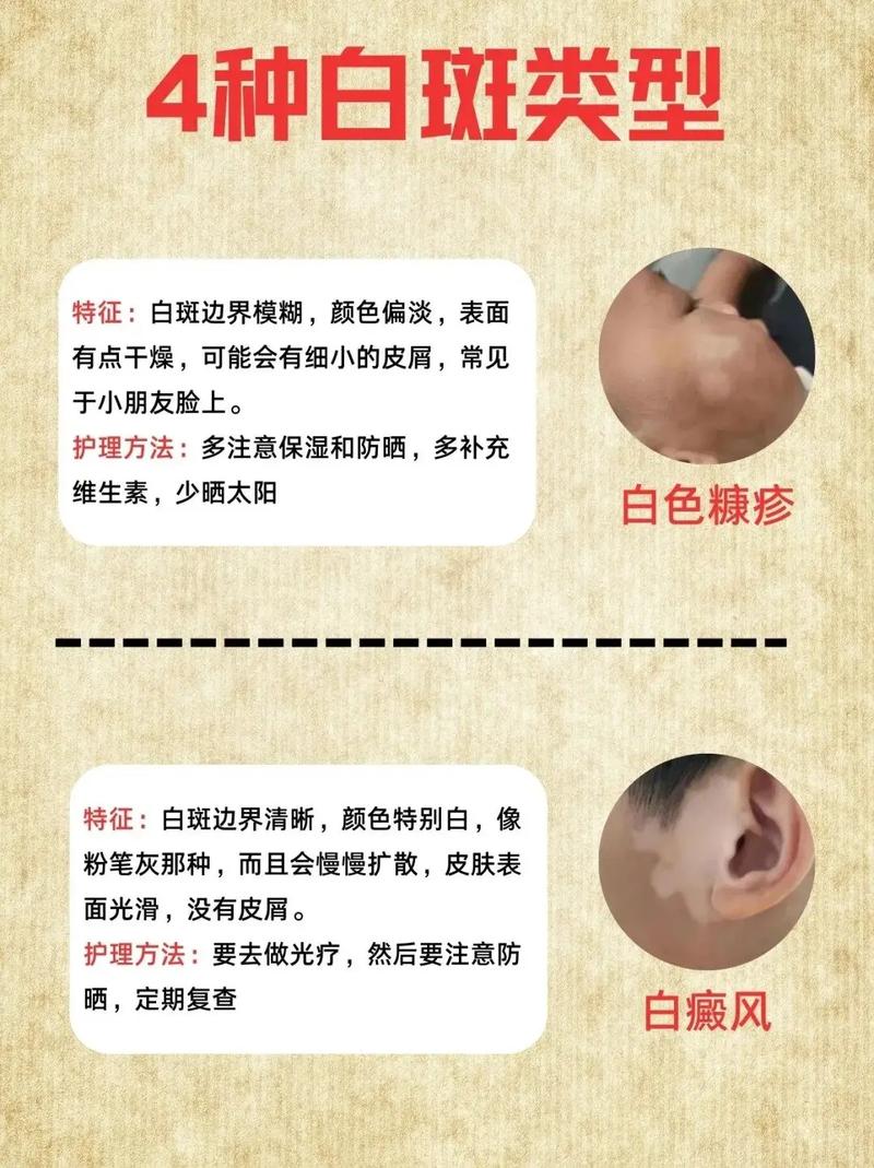 如何确诊是否白癜风 如何判断是否患有白癜风 如何确诊是否白癜风 如何判断是否患有白癜风