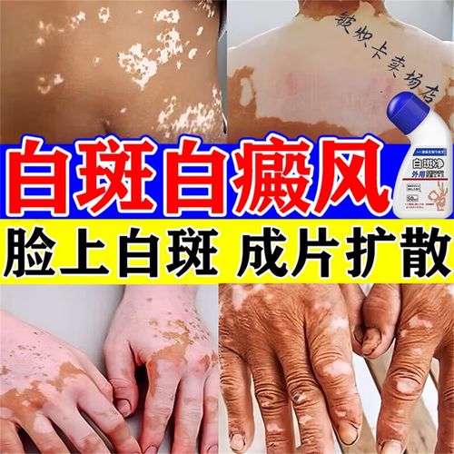 成都白癜风的治疗较好医院在哪 白癜风疾病是什么原因引起的 成都白癜风的治疗较好医院在哪 白癜风疾病是什么原因引起的