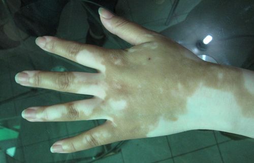 黄石治白癜风的医院哪个正规 得了白癜风怎么护理 黄石治白癜风的医院哪个正规 得了白癜风怎么护理