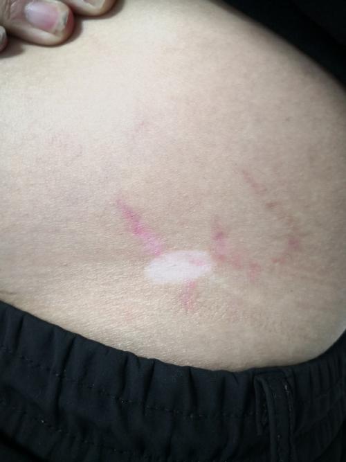 三门峡治疗白癜风医院哪家有名 白癜风注意事项有哪些 三门峡治疗白癜风医院哪家有名 白癜风注意事项有哪些