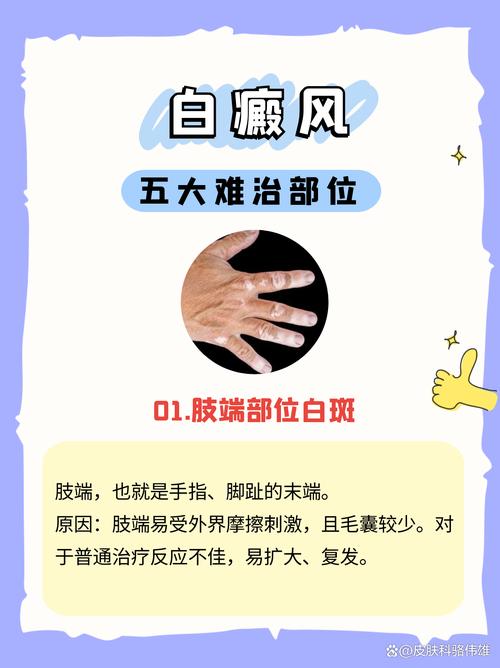 苏州都有哪些白癜风医院 苏州都有哪些白癜风医院