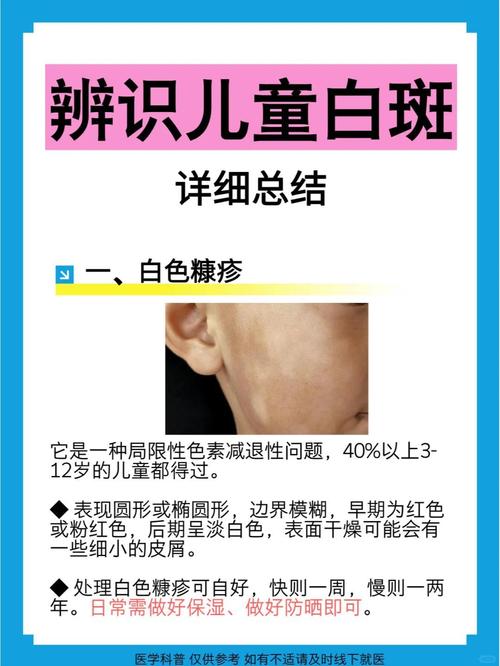厦门哪家医院可以治白癜风 如何正确使用家用光疗仪治疗白癜风 厦门哪家医院可以治白癜风 如何正确使用家用光疗仪治疗白癜风