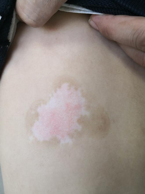 烟台治疗白癜风医院哪家好 外伤性白癜风遗传吗 烟台治疗白癜风医院哪家好 外伤性白癜风遗传吗