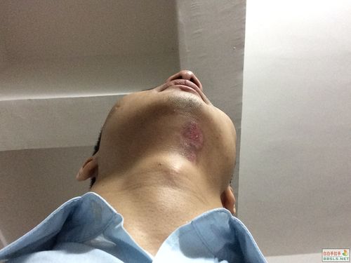 �ȷ��ΰ����ҽԺ������ С������ĳ���֢״