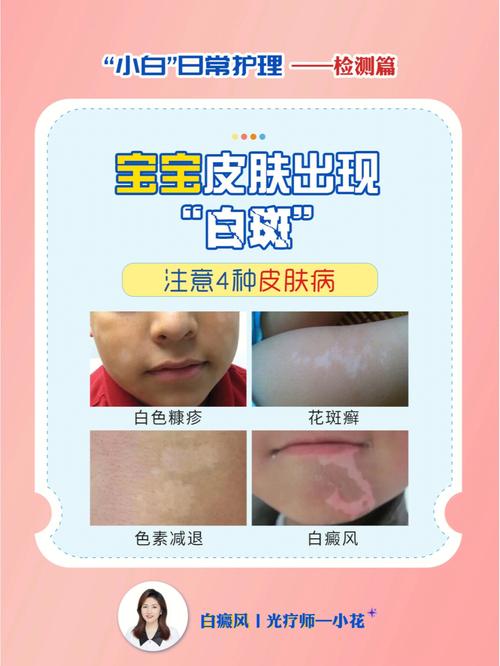 白癜风怎么按摩通经络 白癜风怎么按摩通经络