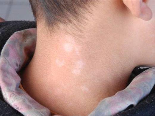 什么医保可以报销白癜风 什么医保可以报销白癜风