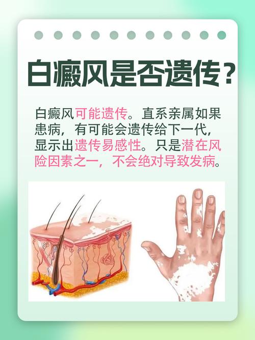 儿童白癜风如何治疗治疗儿童白癜风有什么方法 儿童白癜风如何治疗治疗儿童白癜风有什么方法