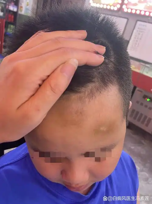 国内哪里看白癜风好 国内看白癜风最好的医院 国内哪里看白癜风好 国内看白癜风最好的医院