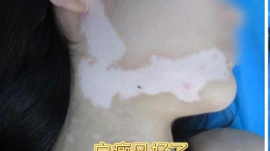 ��ҽ���ư���ķ�������Щ �ȷ����ư����ҽԺ�ĸ���