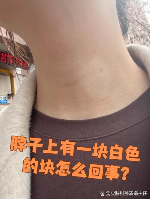 上海治疗白癜风的方法 上海治疗白癜风的方法