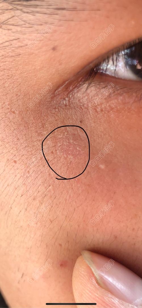 天门白癜风指定帅海林 天门白癜风指定帅海林