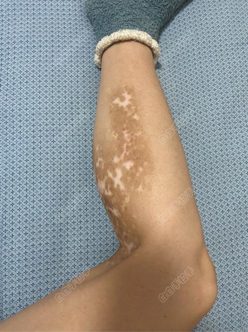 白癜风什么阶段最花钱 白癜风什么阶段最花钱