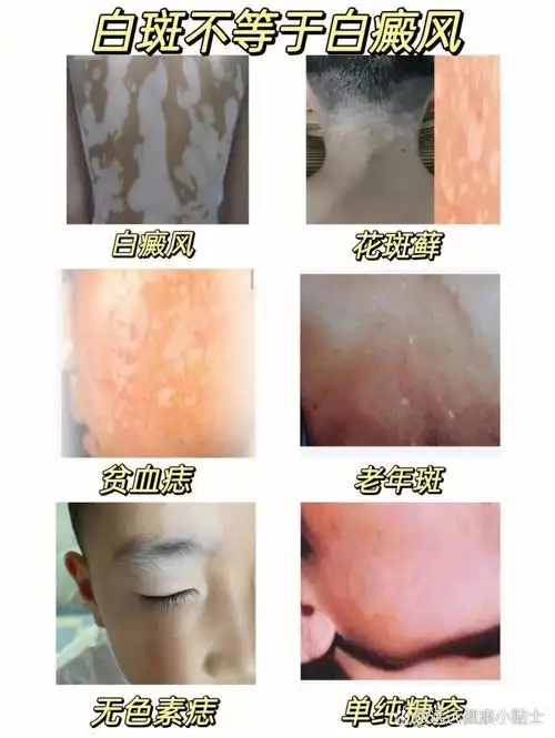 身上白癜风可以参军吗 身上白癜风可以参军吗