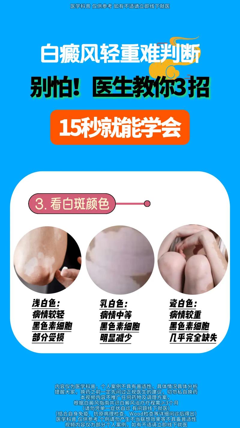 南通治白癜风 南通治白癜风需要多少钱 南通治白癜风 南通治白癜风需要多少钱