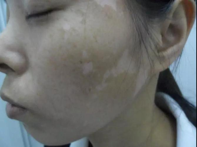 只要做到这5步 就可远离白癜风 只要做到这5步 就可远离白癜风