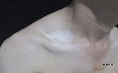 老年白癜风是怎样引起的 许昌有哪些专治白癜风的医院 老年白癜风是怎样引起的 许昌有哪些专治白癜风的医院