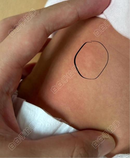 ���ư��粡�ķ��� ���ư�����ʲô����