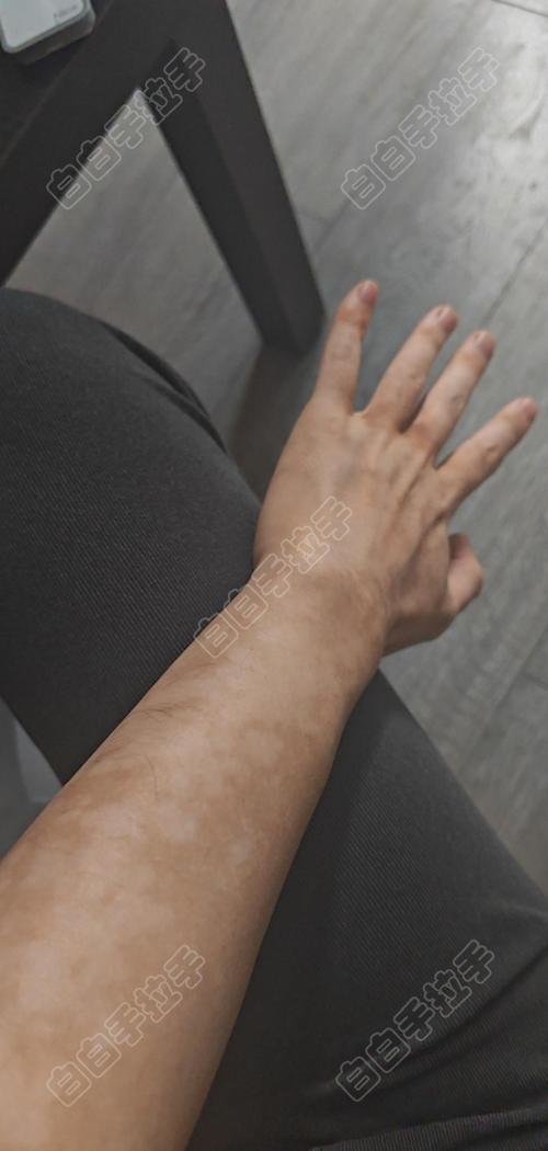 տ�����ư����ҽԺ����� ֫���Ͱ�����ʲô�õ����Ʒ���