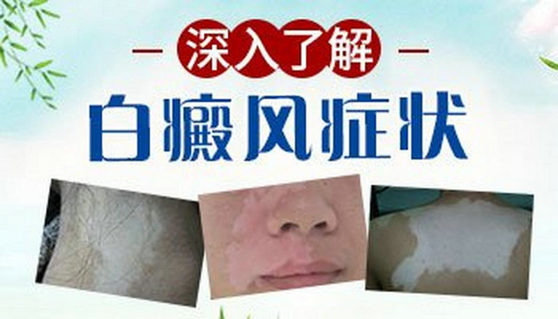 衡阳治疗白癜风选哪家医院 背部白癜风的早期症状有哪些 衡阳治疗白癜风选哪家医院 背部白癜风的早期症状有哪些