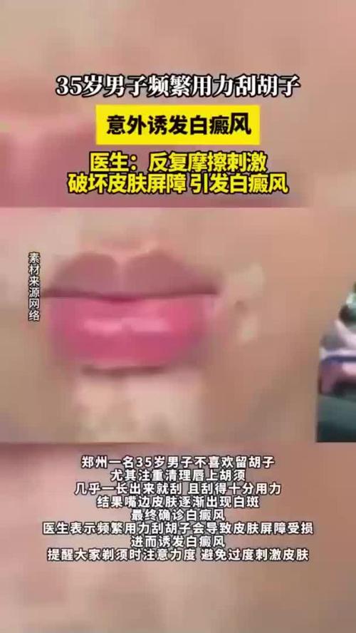 台州专治白癜风医院皮肤出现白癜风后如何护理 台州专治白癜风医院皮肤出现白癜风后如何护理