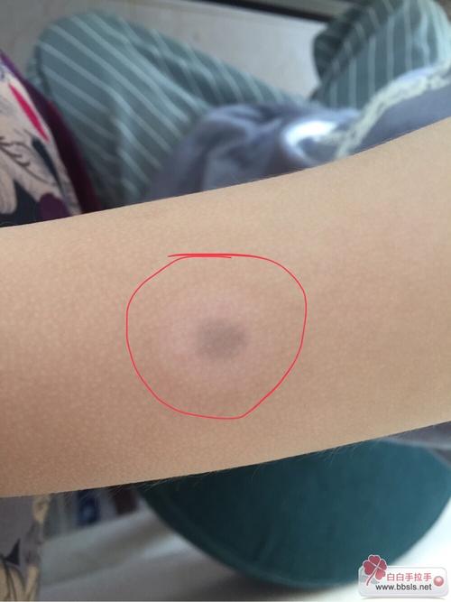 特异性皮炎引起白癜风 特异性皮炎引起白癜风