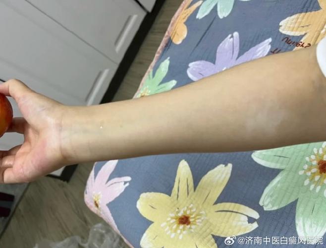 Ϋ�����ư���õ�ר��ҽԺ ����Ͱ׻����кβ�ͬ