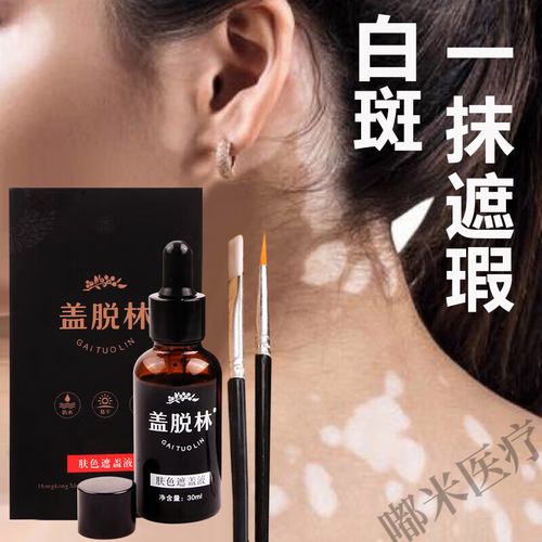 山西临汾产白癜风药 山西治疗白癜风医生 山西临汾产白癜风药 山西治疗白癜风医生