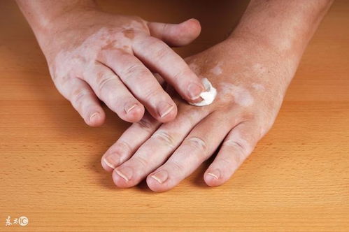 妇科手术被拍照 做妇科手术为什么要拍胸片 妇科手术被拍照 做妇科手术为什么要拍胸片