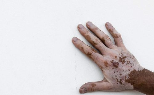 百姓口碑 沈阳白癜风医院医生推荐实力公开白癜风怎么预防扩散 百姓口碑 沈阳白癜风医院医生推荐实力公开白癜风怎么预防扩散