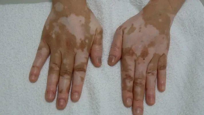 上海白癜风专家李海鸥 上海白癜风专家李海鸥