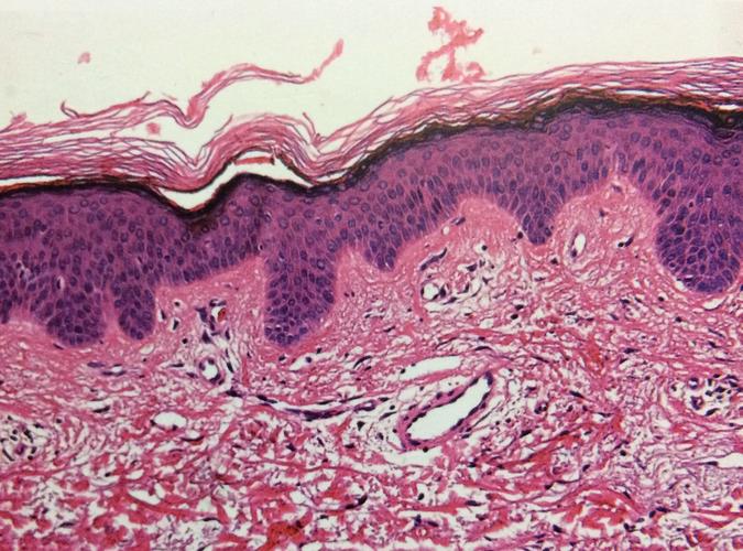火烧后会有白癜风吗_火烧伤留下的白斑可以恢复吗 火烧后会有白癜风吗_火烧伤留下的白斑可以恢复吗