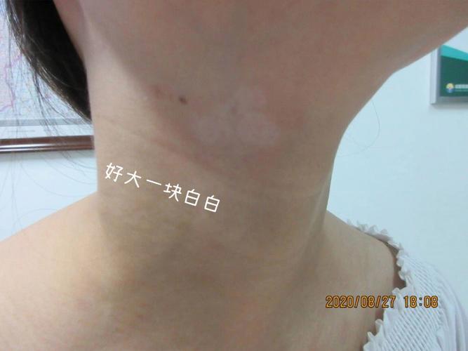 吃中药治疗阴痒白癜风 吃中药治疗阴痒白癜风