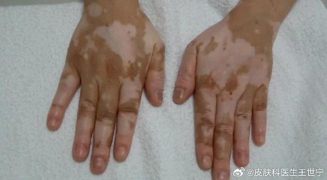 治疗白癜风配合什么药 治疗白癜风配合什么药