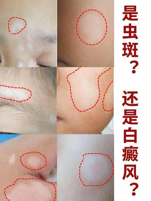 哈尔滨哪些医院专治白癜风 激素治疗白癜风有哪些副作用 哈尔滨哪些医院专治白癜风 激素治疗白癜风有哪些副作用