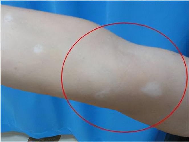 白癜风饮食禁吃什么 白癜风饮食禁吃什么食物 白癜风饮食禁吃什么 白癜风饮食禁吃什么食物