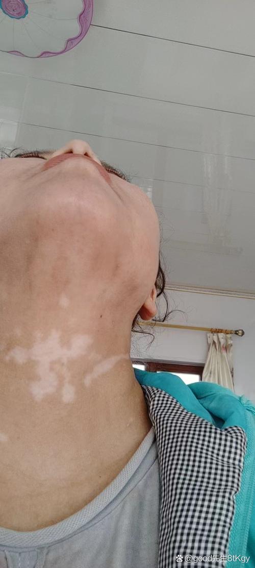 长春治疗白癜风有效果的医院 白癜风早期怎么治疗 长春治疗白癜风有效果的医院 白癜风早期怎么治疗