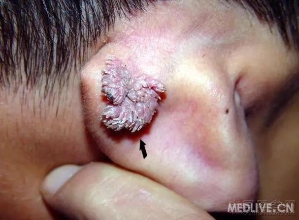 С������֢״����ʲô���� ��������Щ�ΰ����ҽԺ