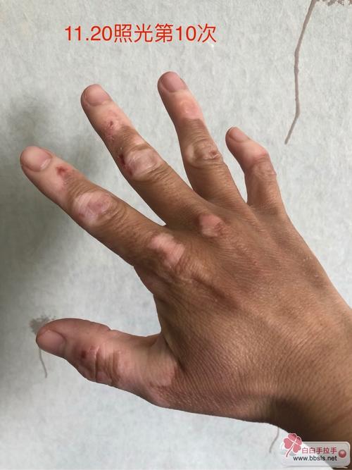 海口治疗白癜风的好医院 小孩白癜风的初期症状 海口治疗白癜风的好医院 小孩白癜风的初期症状