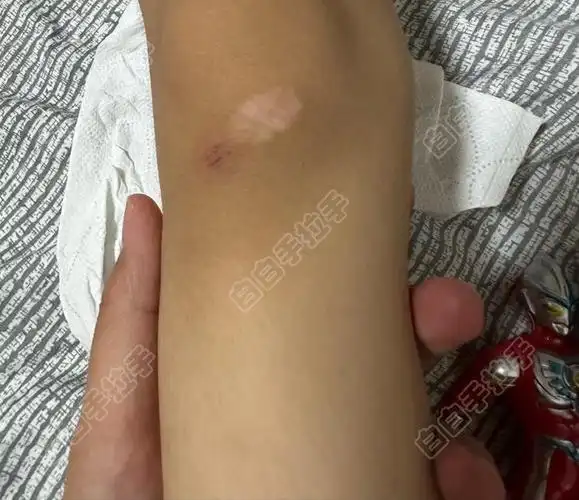 白癜风的健康宣教动画 白癜风的健康宣教动画