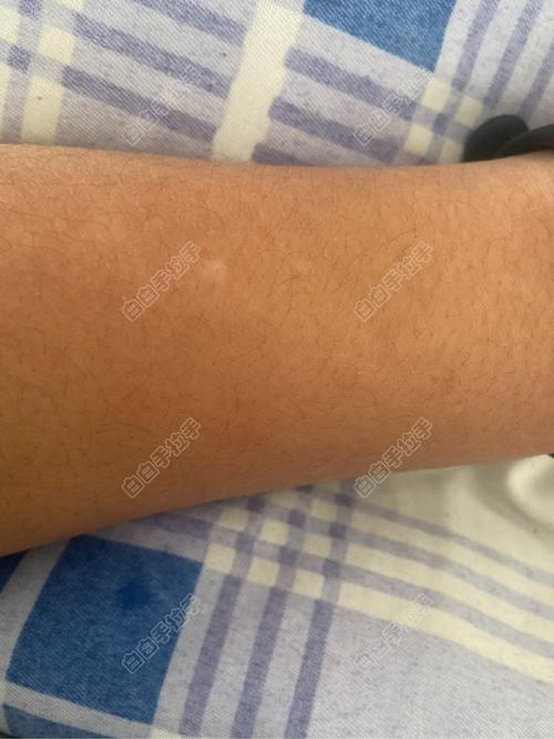 ˫�Ȱ���ʲô֢״ ˫�Ȱ׵�����Ϊʲôԭ��