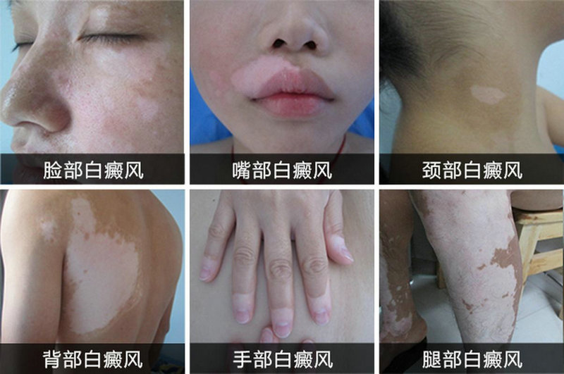 ����֢״�ص���ʲô տ���ļ�ҽԺұ�����