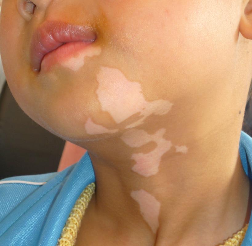 白癜风造成的危害极大 白癜风造成的危害极大