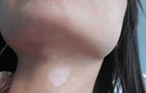 确诊白癜风要做什么 确诊白癜风要做什么手术 确诊白癜风要做什么 确诊白癜风要做什么手术