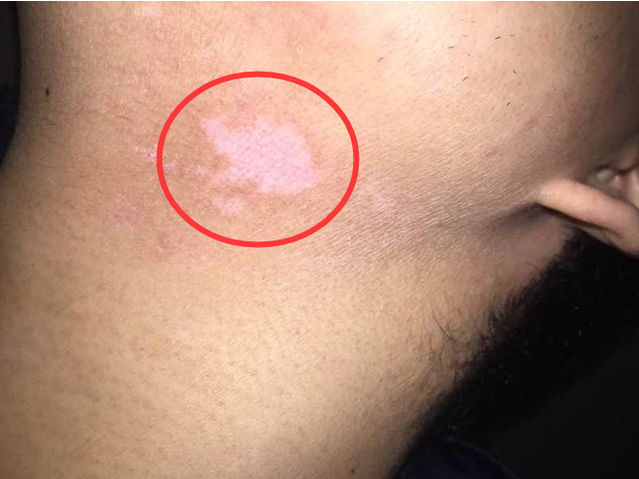 ��Զרҵ�ΰ���ҽԺ ����������Ƥ��ֲ������ô����