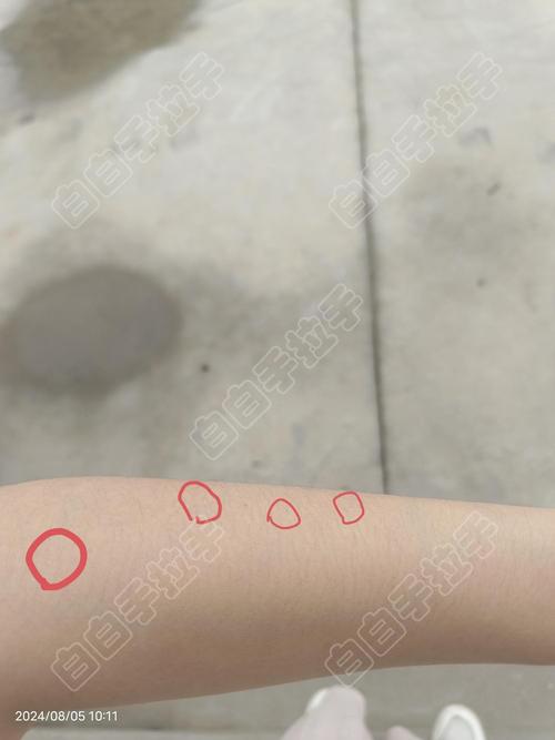 白癜风和白化病有何不同 自贡治白癜风的医院有哪些 白癜风和白化病有何不同 自贡治白癜风的医院有哪些